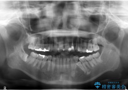 埋まっている奥歯を引っ張り出す　インビザライン矯正の治療前