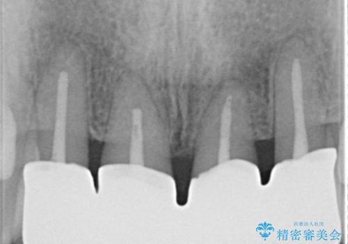 侵襲性歯周炎。前歯の歯周補綴の治療後