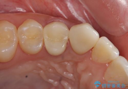 虫歯で歯が折れた セラミック審美修復の治療後