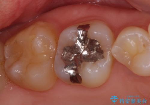 深い咬み合わせと奥歯のむし歯　総合歯科治療の治療前