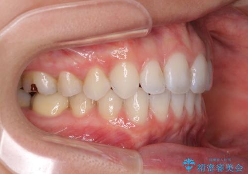 深い咬み合わせと奥歯のむし歯　総合歯科治療の治療後