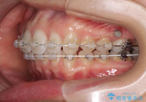 深い咬み合わせと奥歯のむし歯　総合歯科治療の治療中