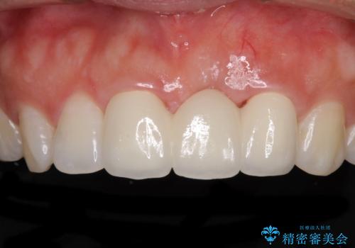 前歯のブリッジが気に入らない　歯肉移植術を併用した前歯のブリッジの症例 治療後