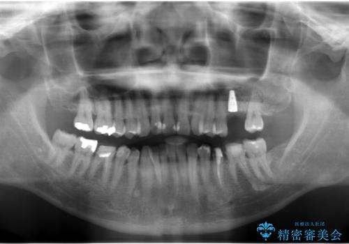 上の奥歯のインプラント、全体的な虫歯治療の治療中