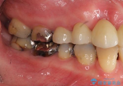 過度な咬合力　歯ぎしりで抜けた歯の欠損補綴の治療後