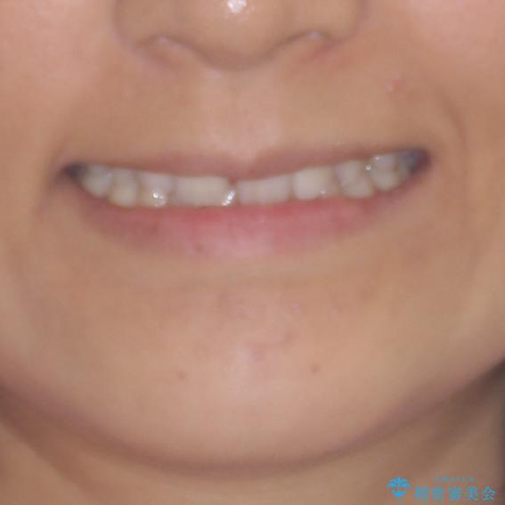 抜歯矯正の後戻りによるすきっ歯をインビザラインでの治療前（顔貌）