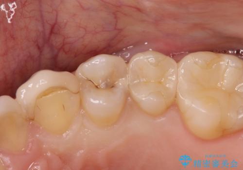 虫歯の治療(セラミックインレー)の治療前