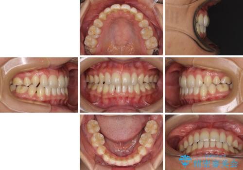 抜歯矯正の後戻りによるすきっ歯をインビザラインでの治療後