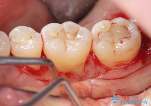 歯周病　再生治療で歯を残すの治療後