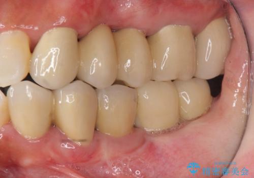 歯周病　側方力に対抗するブリッジ補綴の治療後