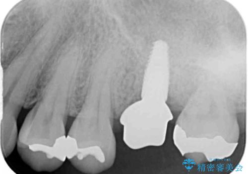 抜歯になった虫歯　奥歯のインプラント治療の治療中