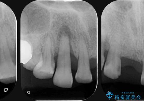 過度な咬合力　歯ぎしりで抜けた歯の欠損補綴の治療前