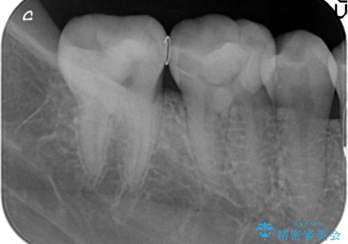 歯の神経を残す、丁寧な虫歯の除去の治療後
