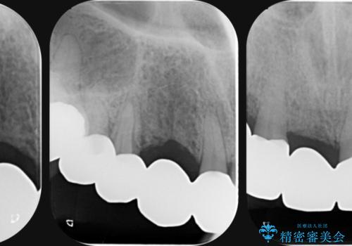 過度な咬合力　歯ぎしりで抜けた歯の欠損補綴の治療後
