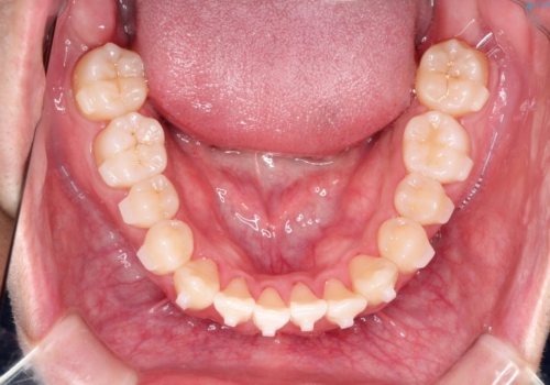 前歯のクロスバイトとガタつきをマウスピース矯正(インビザライン )で治療した症例の治療中
