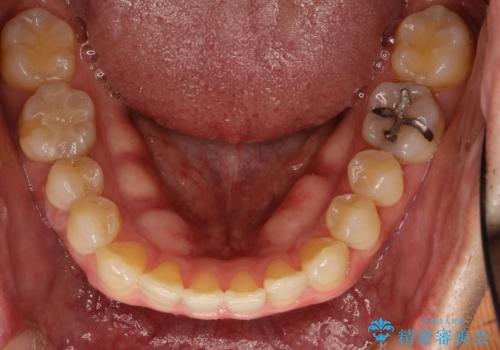 前歯の真ん中の隙間を閉じたい　インビザラインによる目立たない矯正の治療前