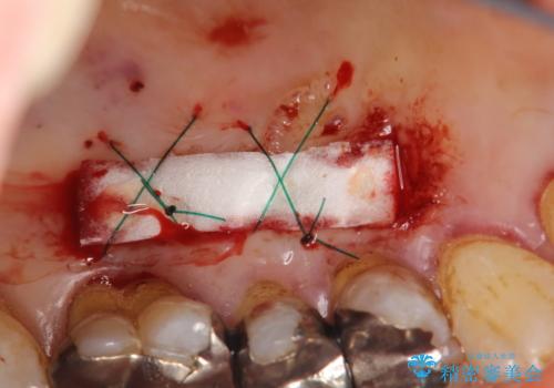 徐々に下がってきた歯肉へ再生療法(歯冠側移動術と結合組織移植術の併用)を施術し、丈夫な歯肉を獲得させた症例の治療後