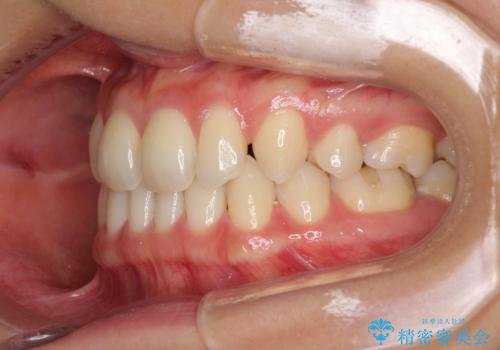 抜歯矯正の後戻りによるすきっ歯をインビザラインでの治療前