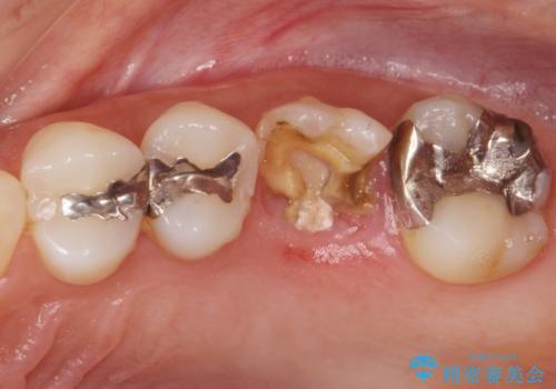 抜歯になった虫歯　奥歯のインプラント治療の治療前
