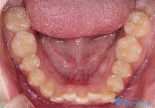 上下の前歯のガタガタを目立たず治したい　インビザラインによる見えない矯正の治療中