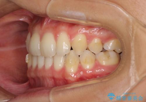 抜歯矯正の後戻りによるすきっ歯をインビザラインでの治療中