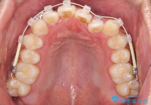前歯が反対にかんでいる　インビザラインとワイヤーを組み合わせた矯正治療の治療中
