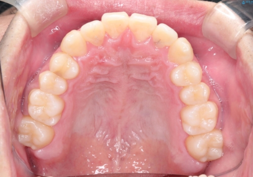 前歯のクロスバイトとガタつきをマウスピース矯正(インビザライン )で治療した症例の治療後