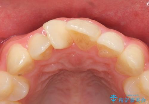 セラミック矯正　気になる前歯の歯並びの改善の治療前