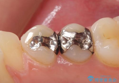 セラミックインレー　銀歯を白い歯への治療前