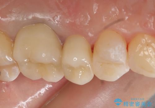 オールセラミッククラウン　セラミックインレー　銀歯を白い歯への治療後