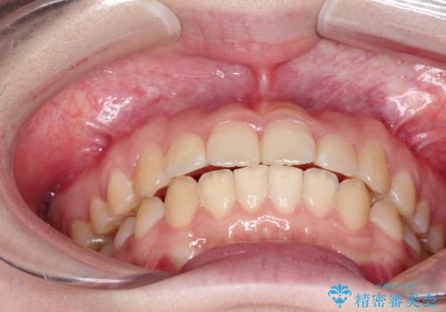 上下の前歯のガタガタを目立たず治したい　インビザラインによる見えない矯正の治療後