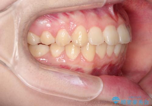 上下の前歯のガタガタを目立たず治したい　インビザラインによる見えない矯正の治療後