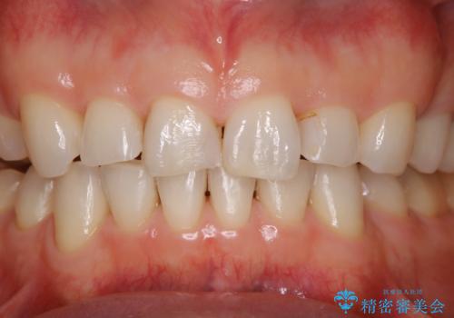 前歯のステイン(着色)をPMTCでキレイにの治療後