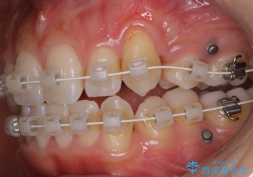 ワイヤー矯正中のPMTCで虫歯・歯周病・口臭予防の治療前