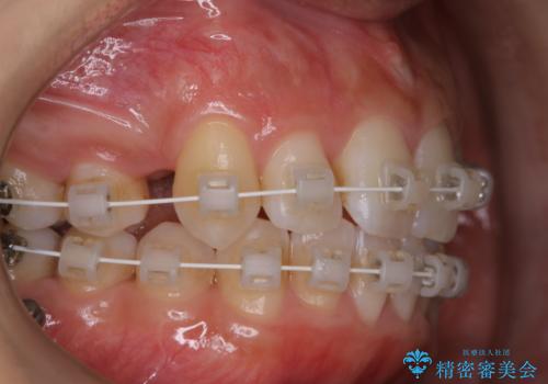 ワイヤー矯正中のPMTCで虫歯・歯周病・口臭予防の治療前