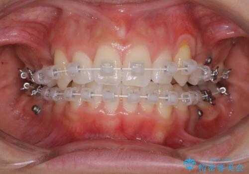 ワイヤー矯正中のPMTCで虫歯・歯周病・口臭予防の治療後