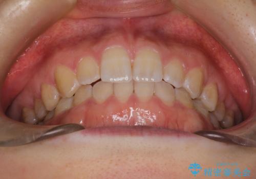 前歯の隙間を閉じたい　インビザラインによる矯正の治療後