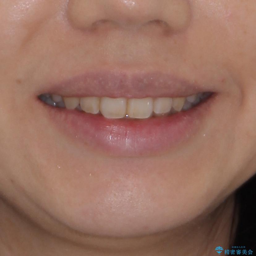 気になる八重歯を治したい　インビザラインと補助装置を用いた抜歯治療の治療後（顔貌）