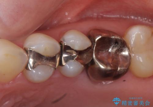 オールセラミッククラウン　セラミックインレー　銀歯を白い歯への治療前