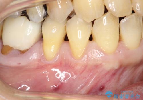 徐々に下がってきた歯肉へ再生療法(歯冠側移動術と結合組織移植術の併用)を施術し、丈夫な歯肉を獲得させた症例の症例 治療前