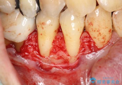 徐々に下がってきた歯肉へ再生療法(歯冠側移動術と結合組織移植術の併用)を施術し、丈夫な歯肉を獲得させた症例の治療後