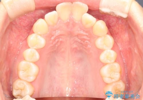 前歯の突出、深い噛み合わせ、ガタつきをマウスピース矯正(インビザライン)で治療した症例の治療前