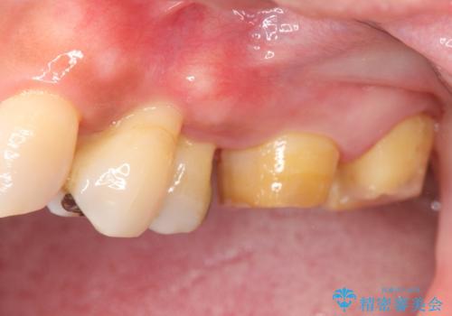 歯周病　側方力に対抗するブリッジ補綴の治療前