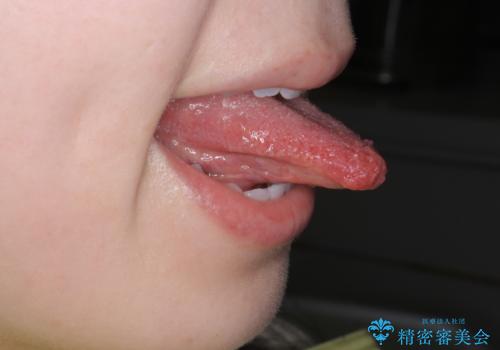 舌小帯の形成の治療後