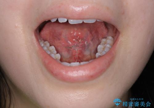 舌小帯の形成の症例 治療後