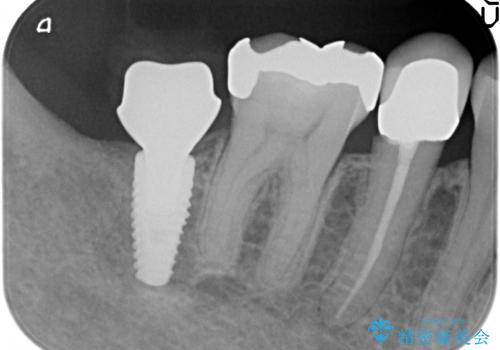 インプラント　抜歯になった奥歯の治療の治療中