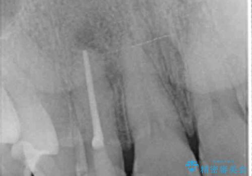 前歯の違和感　失活歯の根管治療とセラミック治療の治療中