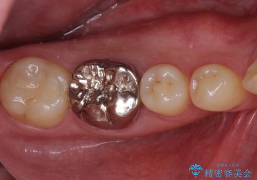 奥歯の目立つ銀歯が気になる　奥歯のセラミッククラウンの治療前