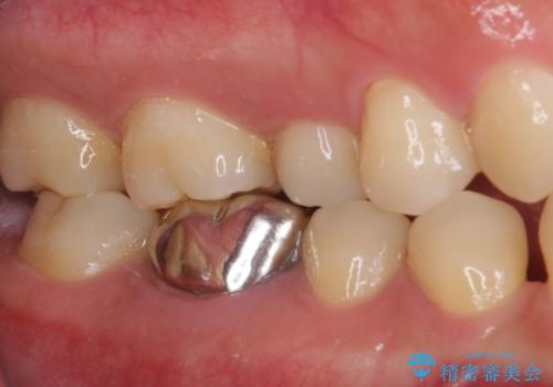 奥歯の目立つ銀歯が気になる　奥歯のセラミッククラウンの治療前