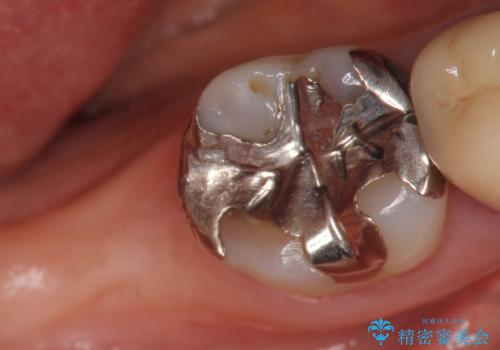 インプラント　抜歯になった奥歯の治療の治療前